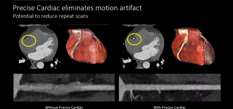 Система компьютерной томографии Philips Spectral CT 7500